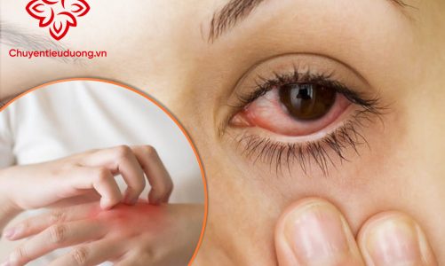 Phòng tránh các bệnh về da và mắt trong mùa mưa bão
