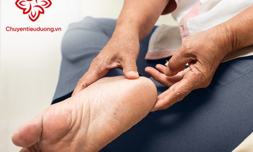 Người bệnh tiểu đường nên bảo vệ bàn chân như thế nào để chống nhiễm khuẩn?